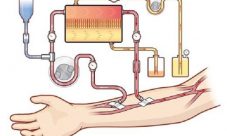 ¿Qué sucede cuando el sistema excretor no funciona?